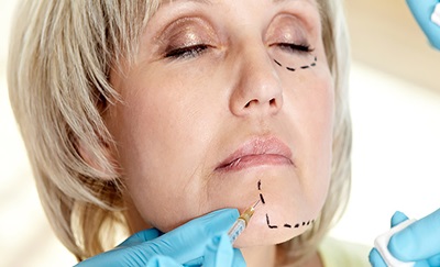 Optegning af linjer på kvindes ansigt før en operation for ansigtsløft