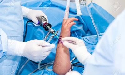 En kirurg afmærker med tusch på en patients hånd, fordi at vedkommende skal udføre en håndledsartroskopi