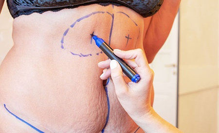 Optegning af linjer på kvindes mave før en abdominalplastik operation.