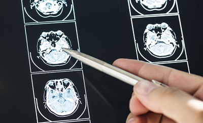 Læge peger på et MR-scanningsbillede af en hjerne med en kuglepen med formodning om epilepsi.
