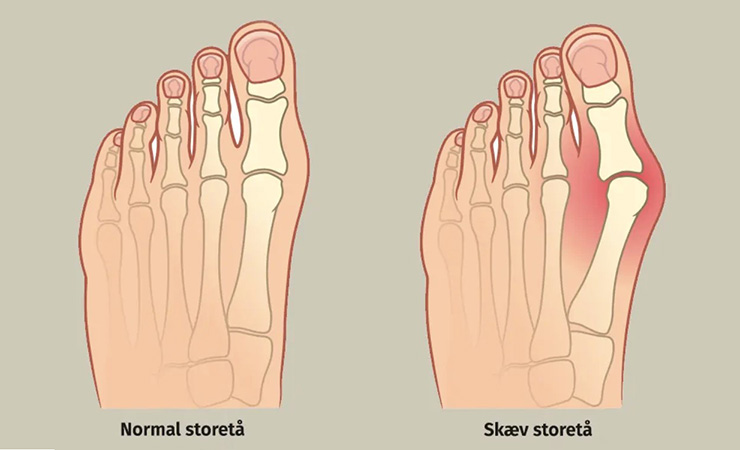 Figur af en normal fod og en fod med en skæv storetå