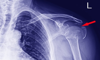Røntgenbillede af en skulder med indeklemningssyndrom