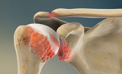 Figur som viser, hvor smerterne ved slidgigt i skulderen sidder.