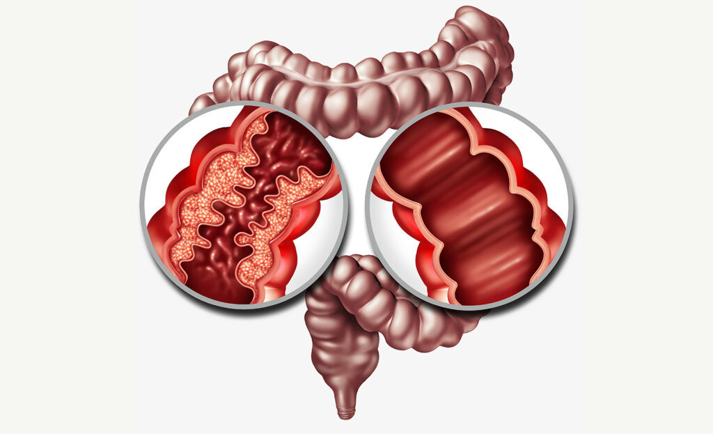 Figur af et tarmsystem med Crohns sygdom